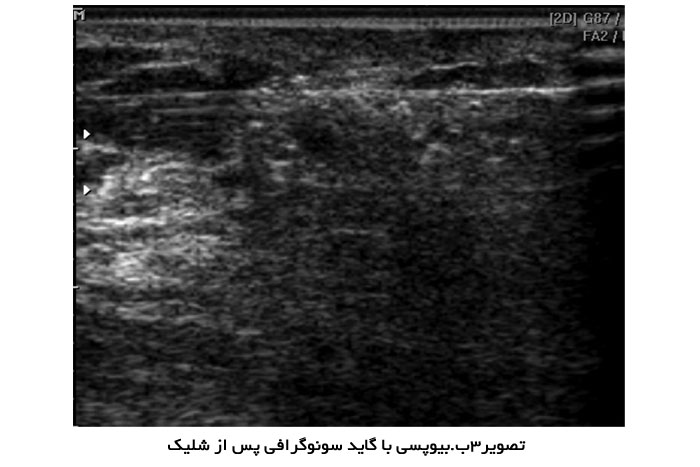 بیوپسی با گاید سونوگرافی پس از شلیک